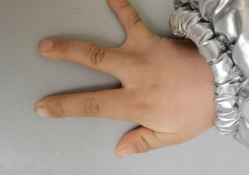 并指畸形免植皮案例,并指畸形