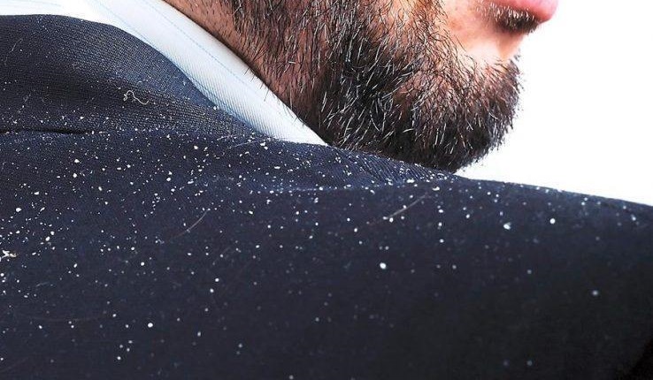 头皮屑特别多要当心什么病,头皮屑的原因跟护理方法