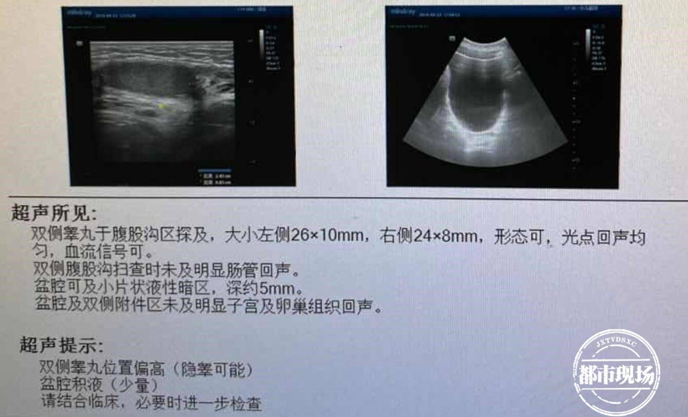 南昌：14岁女孩迟迟不发育，医生发现秘密：“她”是男孩