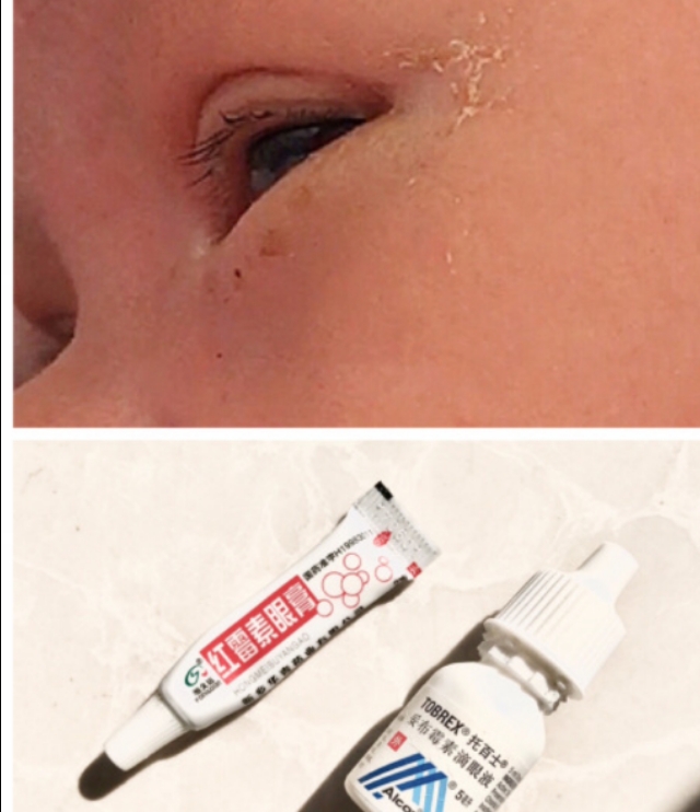 上火眼屎多是什么原因引起的,孩子眼屎多流鼻涕是什么原因