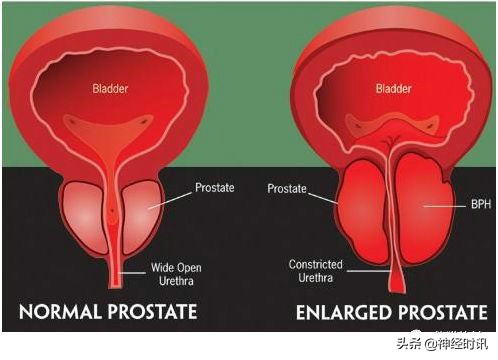 肾脏输尿管膀胱前列腺结构,肾输尿管膀胱解剖示意图