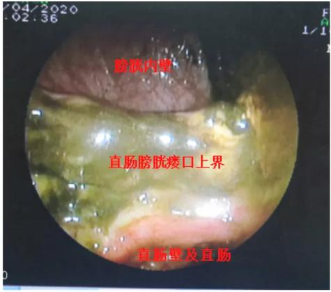 直肠癌晚期手术病例,直肠癌晚期多发性肠梗阻