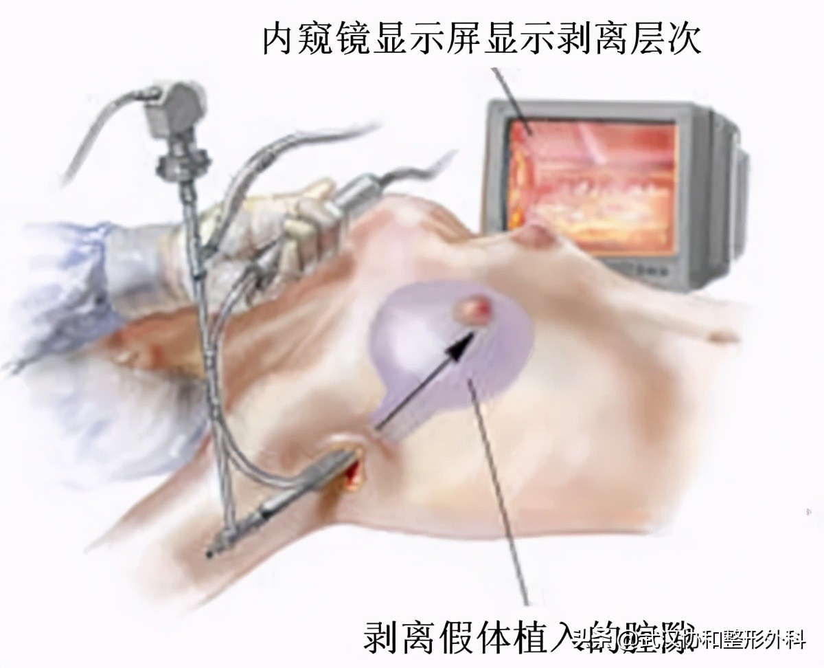 内窥镜隆胸双平面为什么会下垂,最新内窥镜隆胸