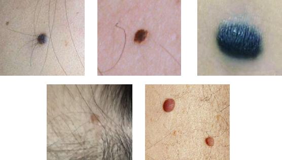 泪痣点痣后会倒霉是真的吗,泪痣点掉了要注意什么