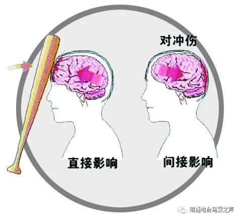脑震荡应该注意事项,脑震荡需要什么休养方式保养