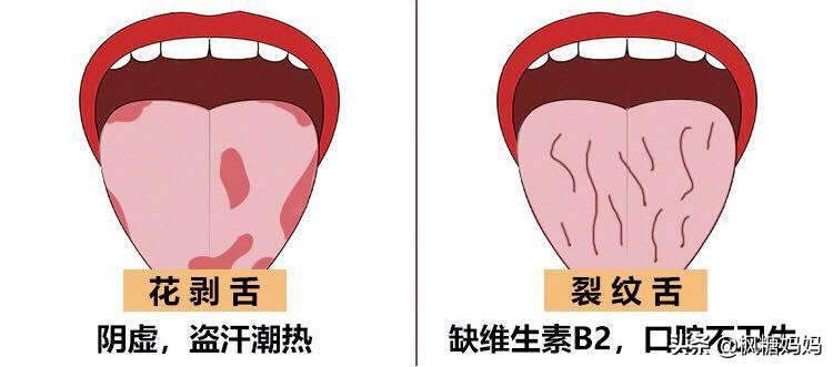 小孩舌头脾胃区有裂纹怎么调理,宝宝脾胃总是弱舌苔又厚怎么调理