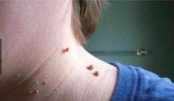 皮肤长出来小疙瘩是什么,皮肤上长了一个小疙瘩看什么科