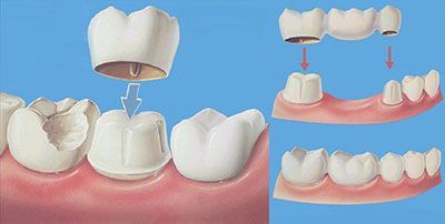 牙冠的常见种类与区别,牙冠什么种类性价比高
