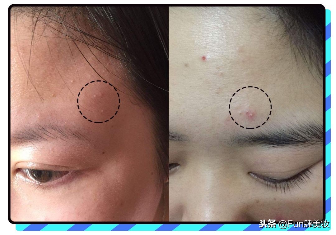 长痘怎么才能不留痘坑,痘肌自救方法视频