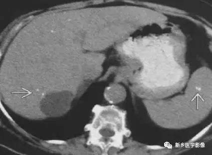 腹部平片可以看出肠胃疾病吗,腹部散在结节状高密度影