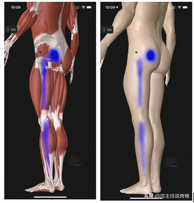 腰突引起的臀部麻腿疼哪个严重,怎样解决腰突带来的臀腿胀痛