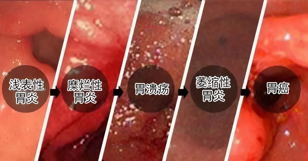 浅表性胃炎伴糜烂的中药处方治疗,浅表性胃炎伴胆汁反流怎么治疗好