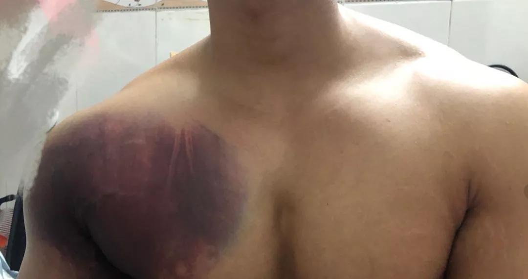 医务人员感染新冠人数,全国3387例医务人员感染新冠肺炎