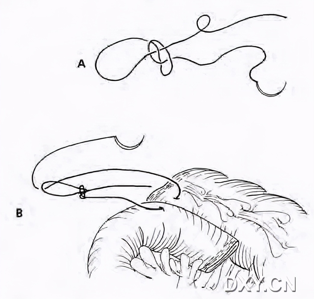 实用大全：腹腔镜下缝合与打结