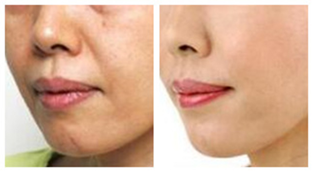 拉皮术除皱后会衰老更快吗,做拉皮手术后皮肤会衰老得更快吗