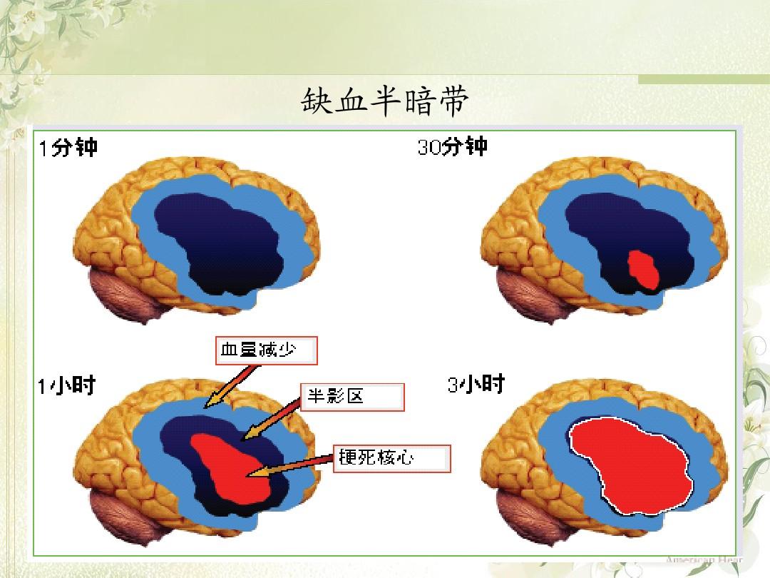 脑梗死一个星期的变化,时间就是生命急救技巧