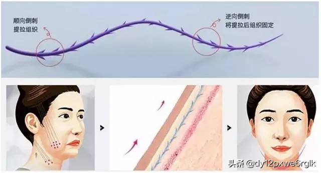 线雕与拉皮哪个除皱效果好,皮肤下垂做拉皮好还是线雕好