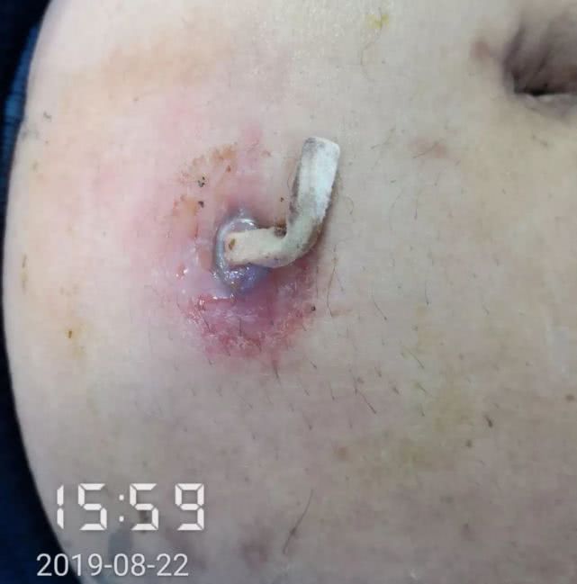 阑尾炎形成窦道的原因,阑尾炎一孔微创手术全过程