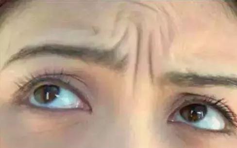 鱼尾纹法令纹抬头纹显老又难看,法令纹鱼尾纹抬头纹哪个最难看