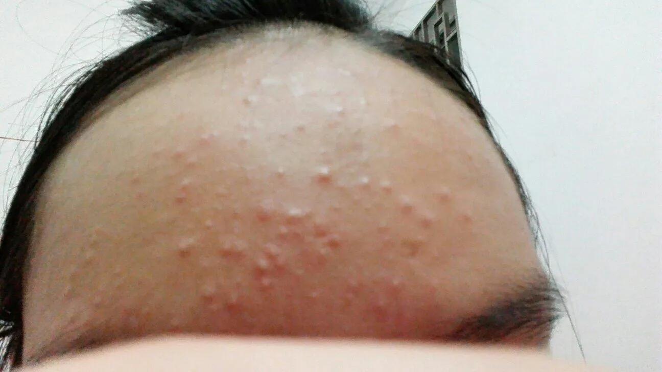 额头发际线长痘是什么原因,更年期额头长痘是什么原因