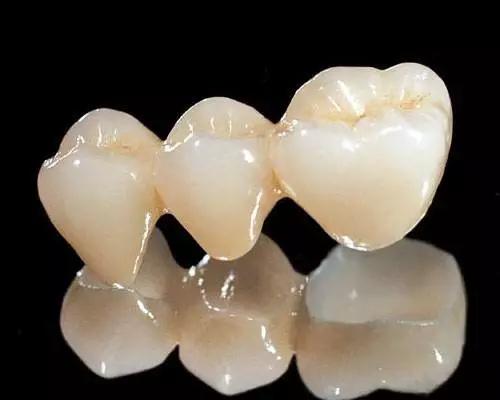 牙冠修复和牙齿贴面哪个比较好,修复牙齿应该先洗牙还是先补牙