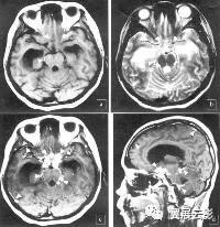 脑部脓肿怎么治疗,多发性脑脓肿能自愈吗