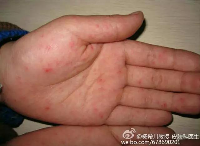 手足口病警惕四种表现,警惕手足口病高发期悄然而至