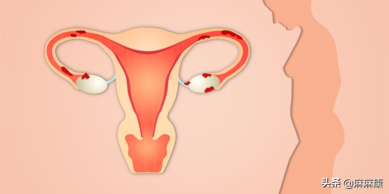 剖腹产10天后恶露干净18天又出血,剖腹产42天恶露没有流干净怎么办