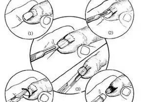 治疗甲沟炎真正有效的办法,甲沟炎指甲剪神器正品