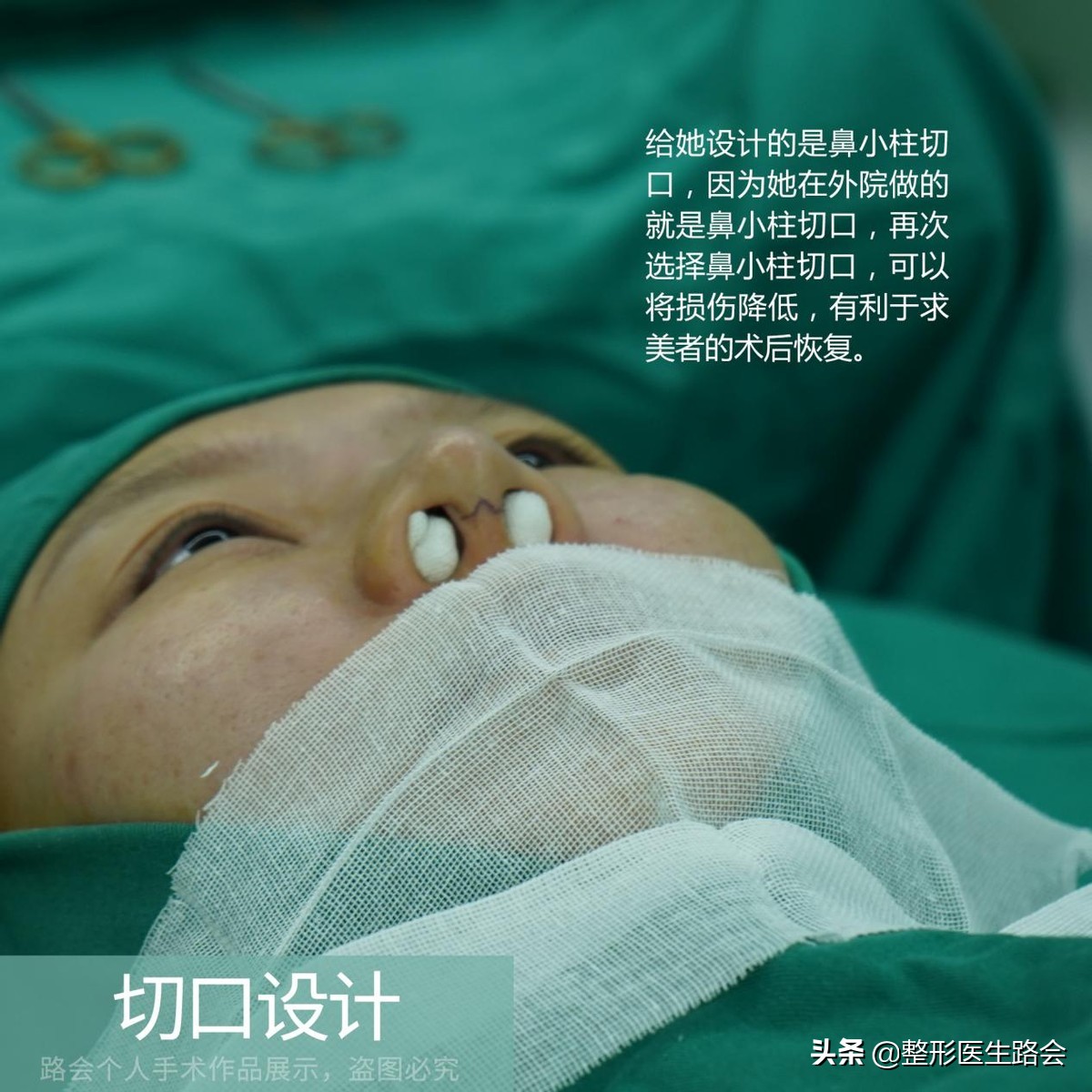 一定得惊艳才好看吗,膨体鼻整形全过程