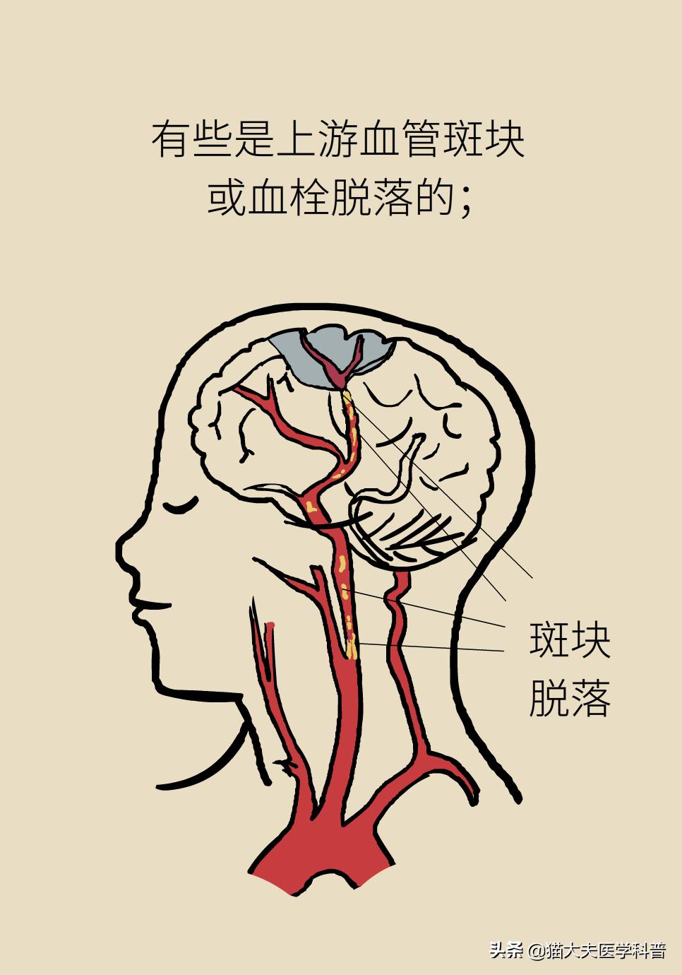 再灌注治疗是什么意思,再灌注治疗