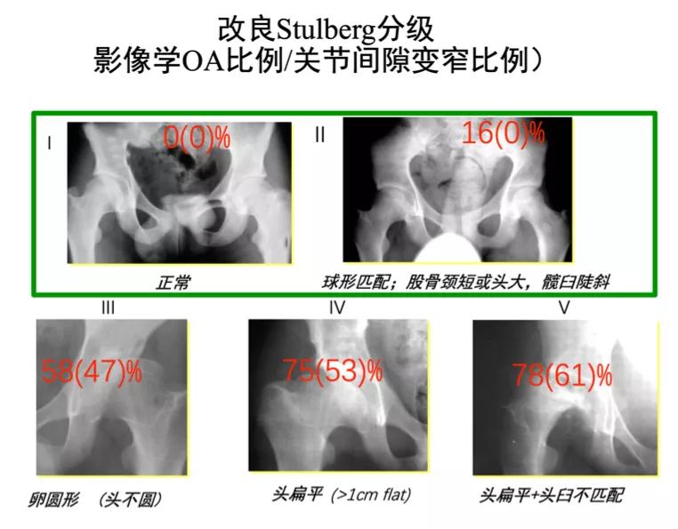 perthes可以治愈么,儿童股骨头坏死指南2020