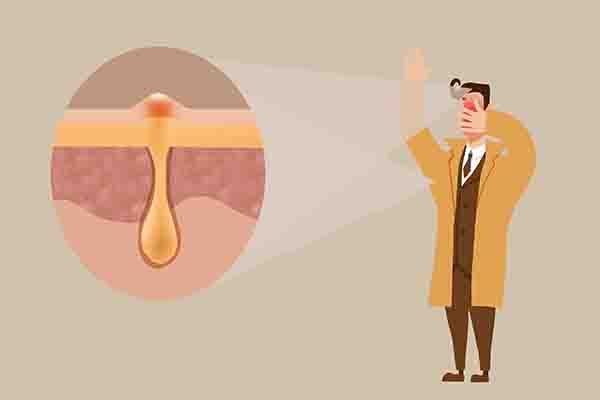 皮肤出油反反复复长痘怎么护肤,脸部出油严重是因为螨虫吗