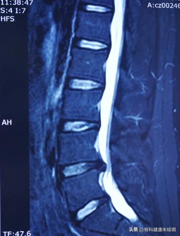 简单高效的治疗腰椎间盘突出,保守治疗腰椎间盘突出的方法