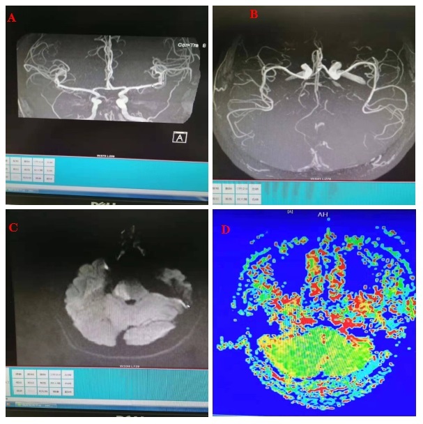 脑梗死错过黄金救治溶栓窗口期,脑梗抢救黄金时间消栓术