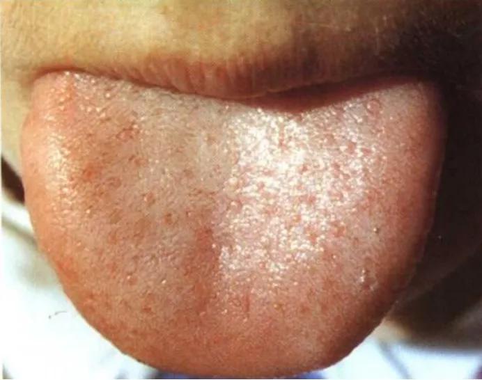 正确的舌诊图解及用药,感冒舌诊