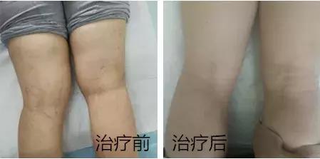 蚯蚓腿新式微创治疗,蚯蚓腿微创手术