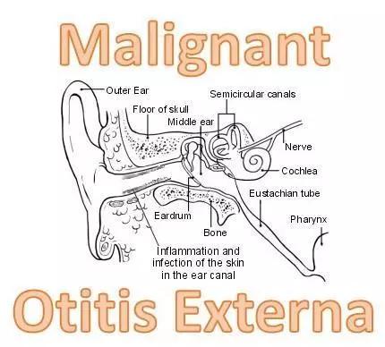用棉签掏耳朵的危害动画,用棉签掏耳朵对身体有害吗