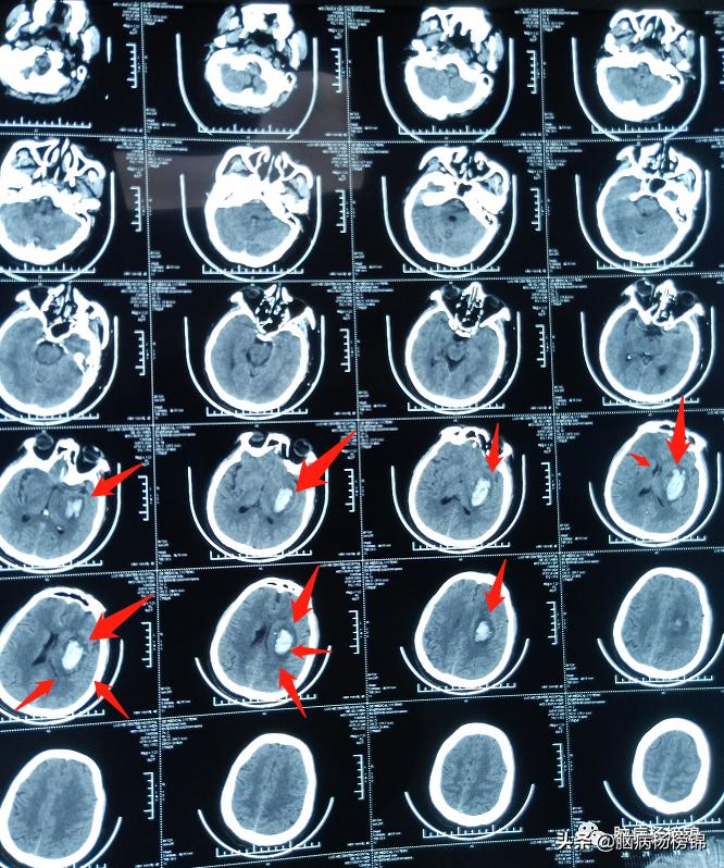 高空掉落脑出血,高处作业会不会引起脑溢血