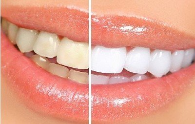 牙齿贴面属于美白还是修复,牙医说全瓷贴面的危害与寿命