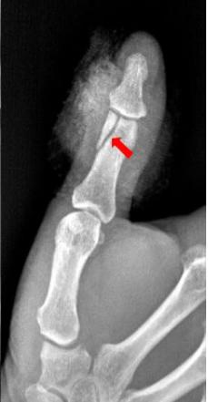 怎样发现骨折的可能性,一招看出手指骨折