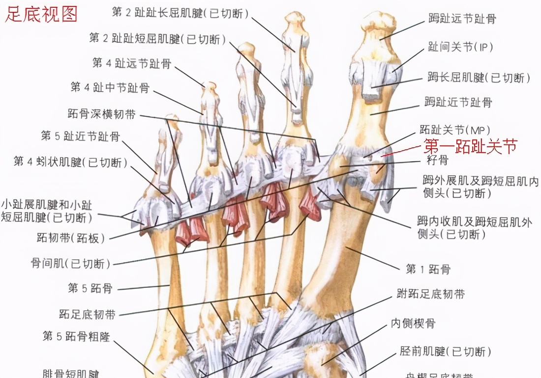 第一跖趾关节扭伤怎么缠绷带,跖趾关节扭伤多久能自愈