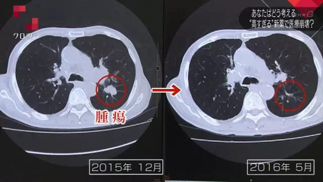 日本老人每个月花费,一位老人得癌症要花多少钱