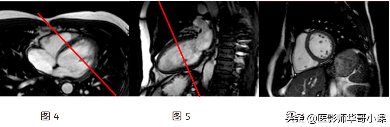 心脏mr增强扫描讲解,磁共振心脏扫描标准切面