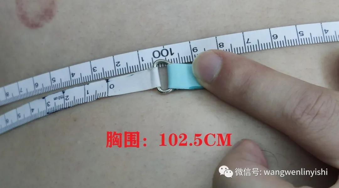 胸围超1米：重度桶状胸，Wenlin手术