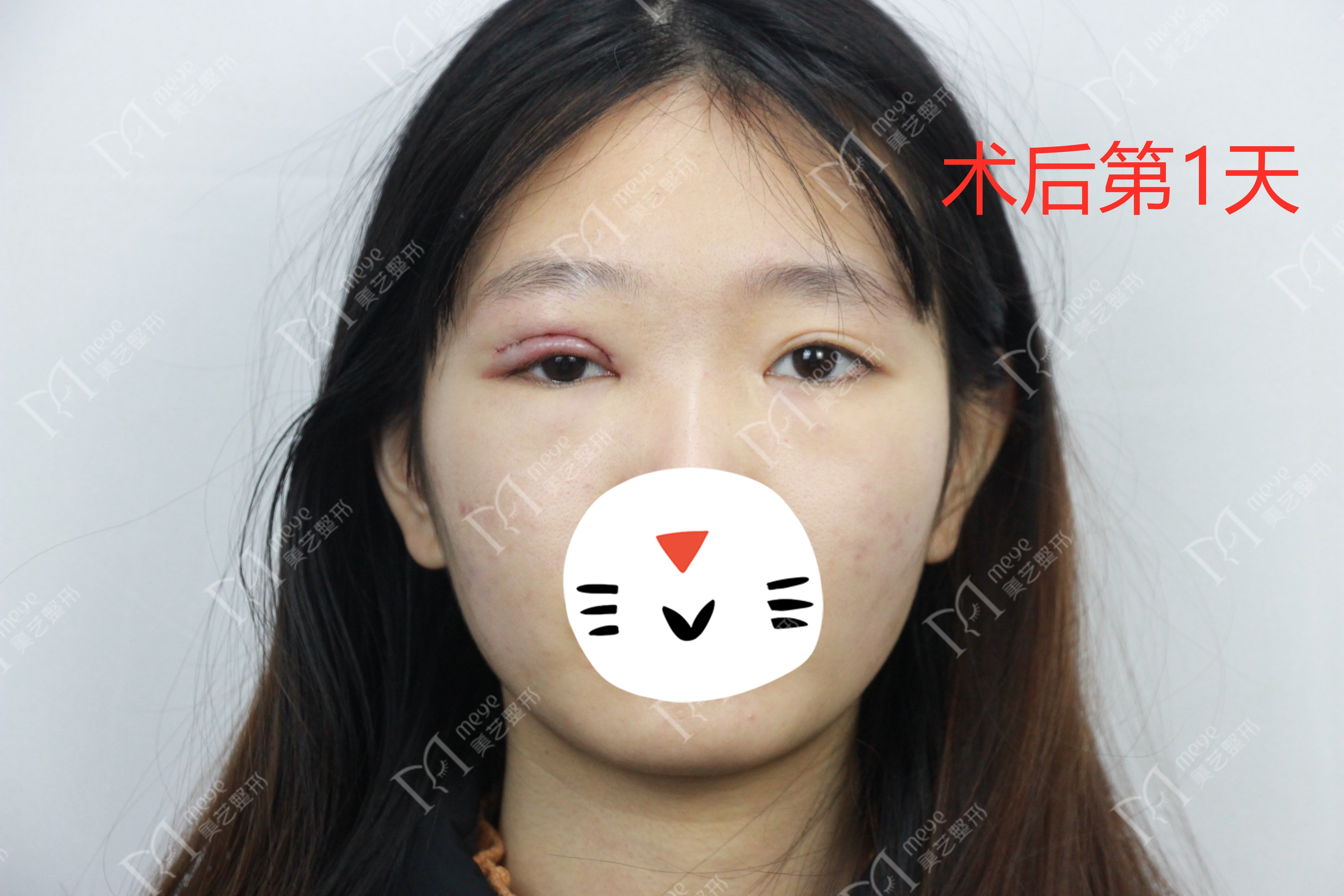 单眼上睑下垂修复术,上睑下垂眼睛修复手术成功率高吗