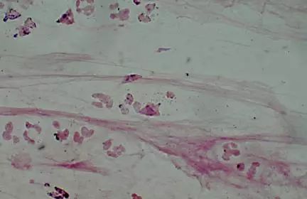 肺炎炎症图片,肺炎病历单图片