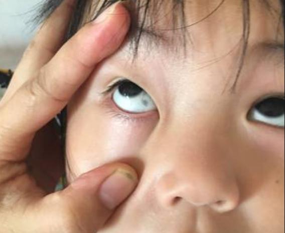 小孩眼白有黑点是啥原因,儿童眼白有黑点是怎么回事