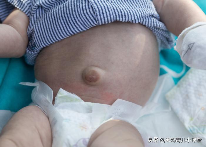 宝宝脐疝怎么处理好得快,宝宝脐疝要怎么处理