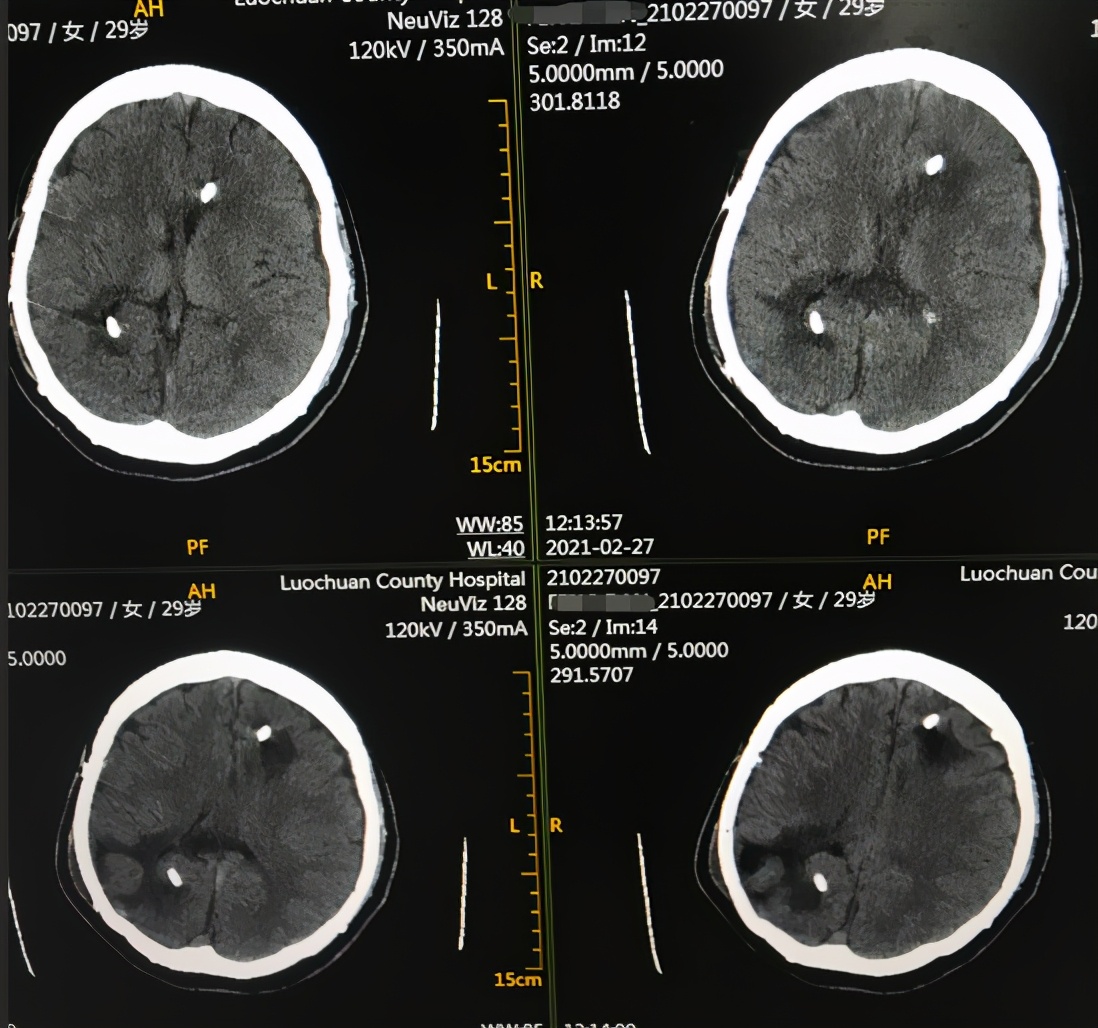 脑室有粘连脑积水有什么办法,脑动脉畸形手术后出现急性脑积水